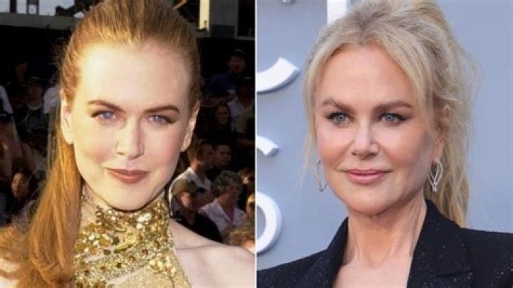 Has Nicole Kidman Had Cosmetic Surgery? Exploring The Rumors